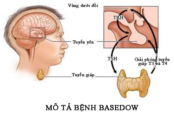 Bệnh cường giáp Basedow là bệnh gì?